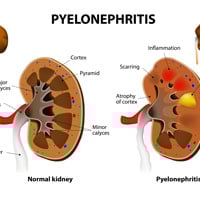 Pyelonephritis/Kidney Infection: Causes, Symptoms And Treatment