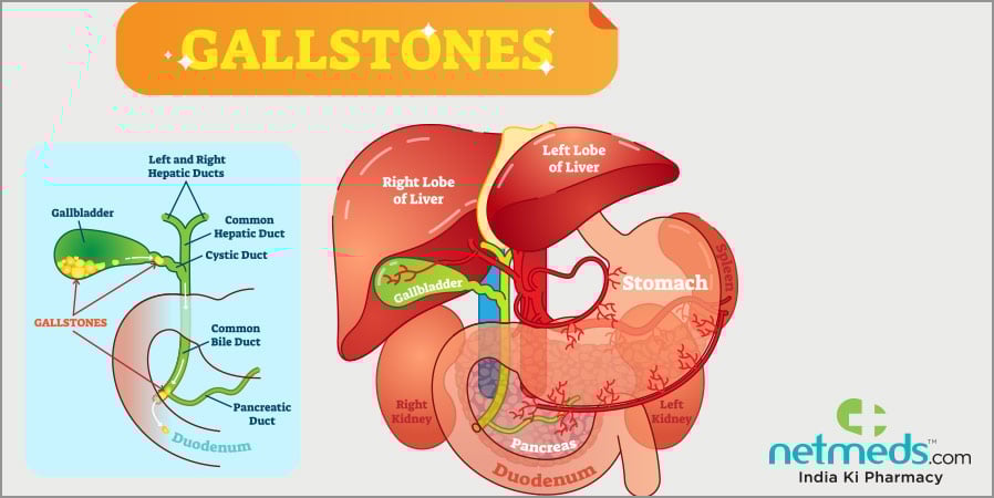 Gallstones