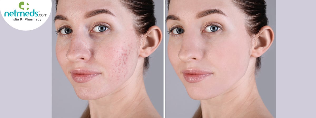 acne precautions