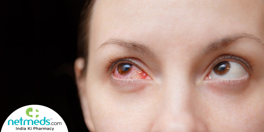 Woman with Conjunctivitis