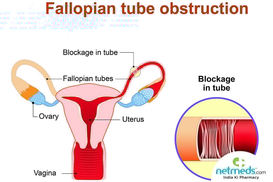 fallopian tube cancer