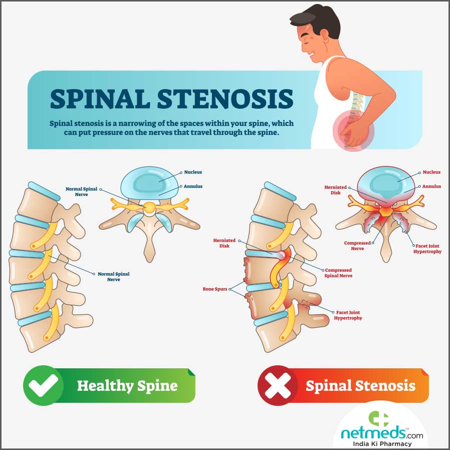 Spinal stenosis