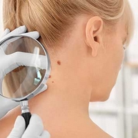 Skin Symptoms That Indicate Prediabetic Conditions