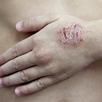 Discoid Eczema: Causes, Symptoms And Treatment