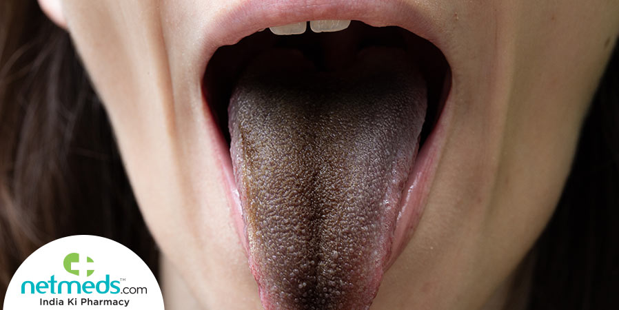 Black Hairy Tongue