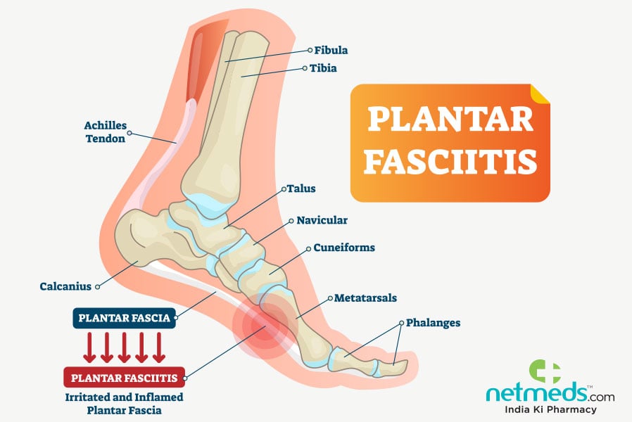 plantar fasciitis