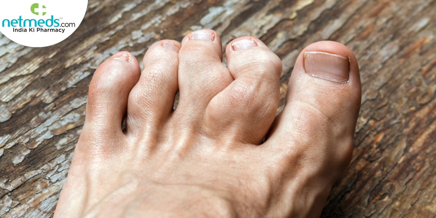 Tophus gout