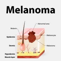 Melanoma: Causes, Symptoms And Treatment