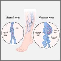 Varicose Veins: Causes, Symptoms And Treatment