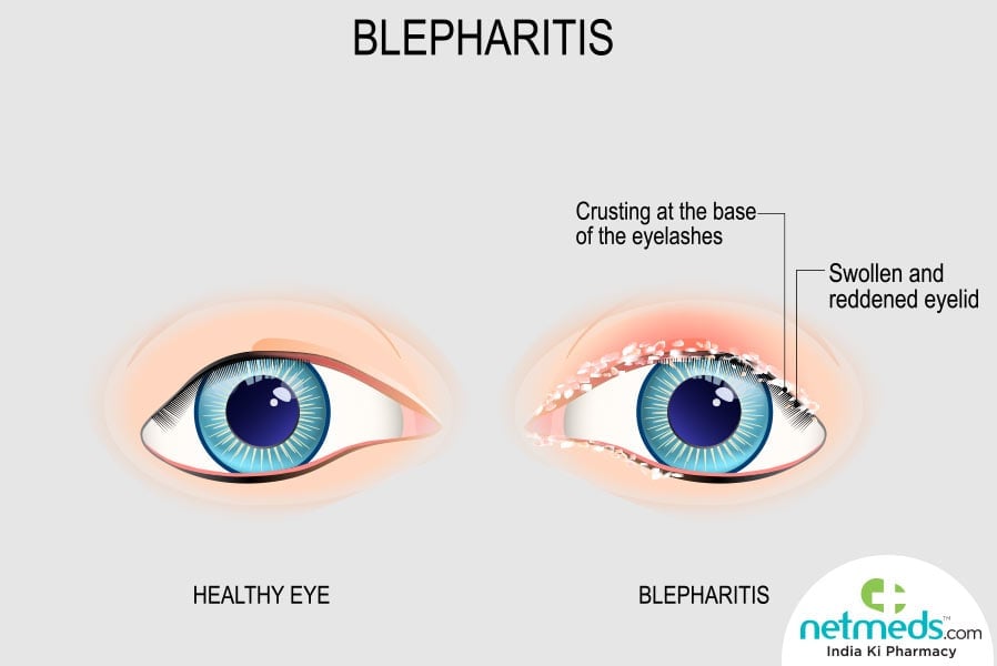 Blepharitis