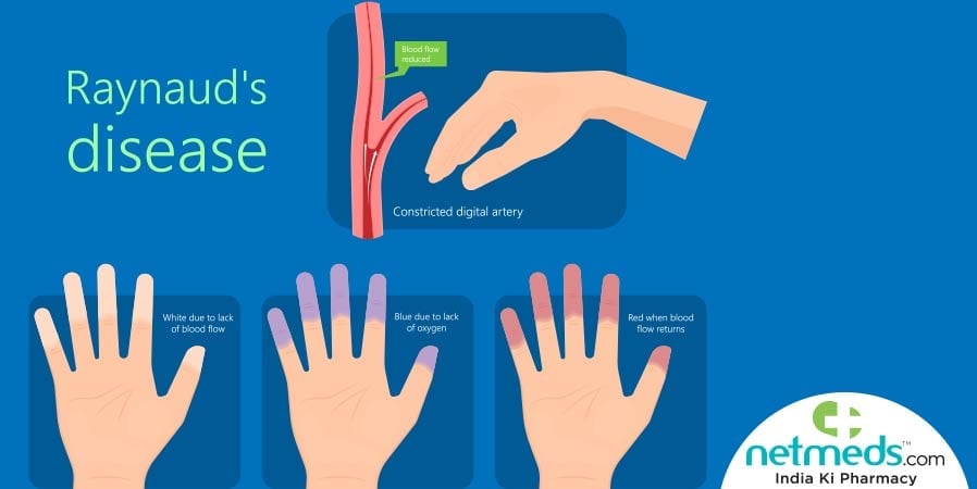 Raynaud's Disease