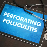 Folliculitis – Causes, Symptoms and Treatment