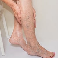 Standing too long? You can develop varicose veins