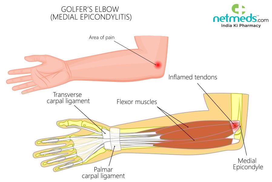 golfer's elbow