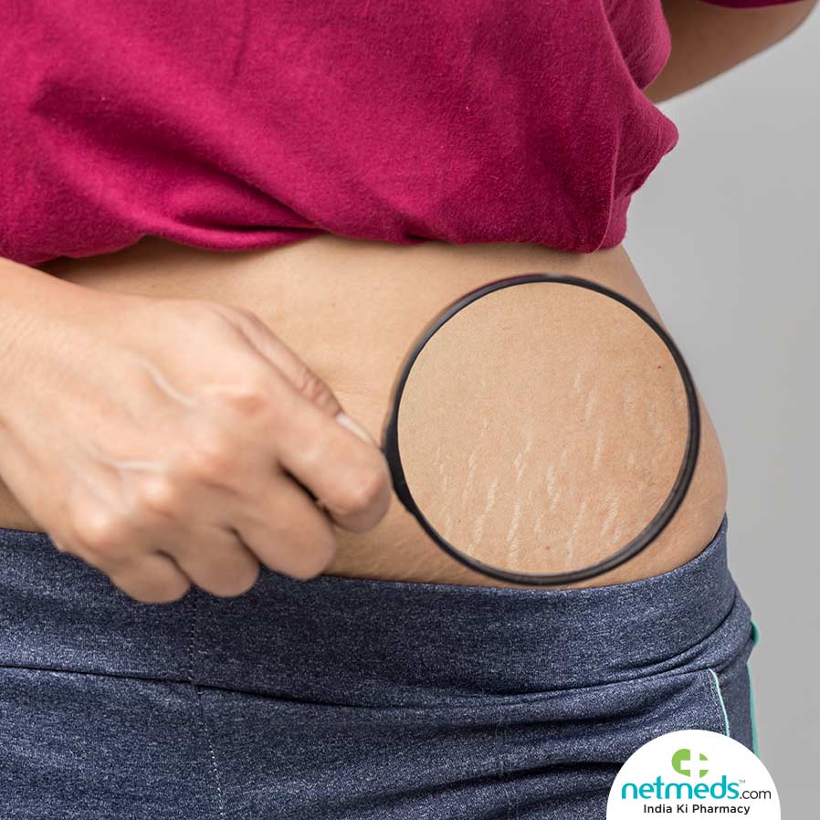 Woman Using Magnifying Glass To See The Stretch Marks