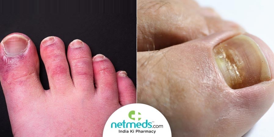 Nail markers of covid-19 infection
