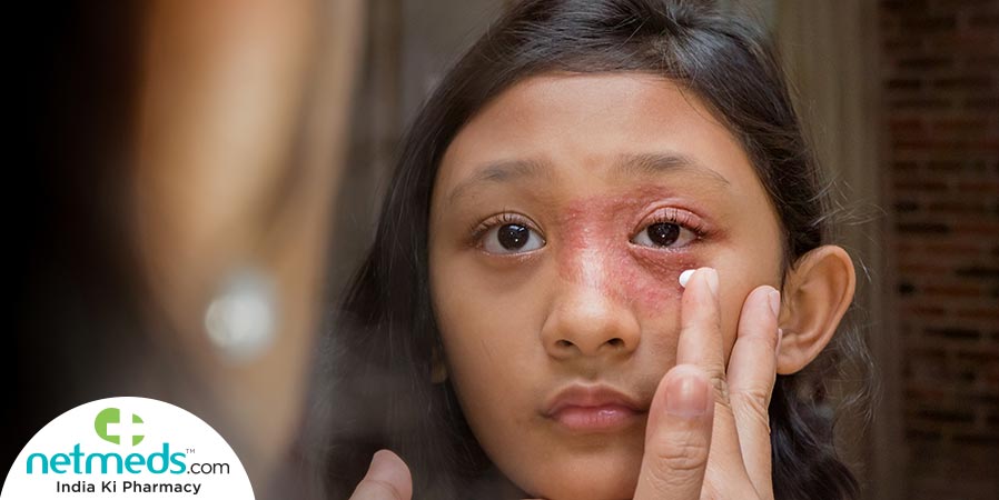 Girl with fungal eye infection