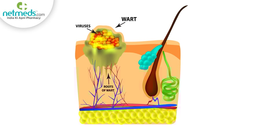 hyperkeratosis