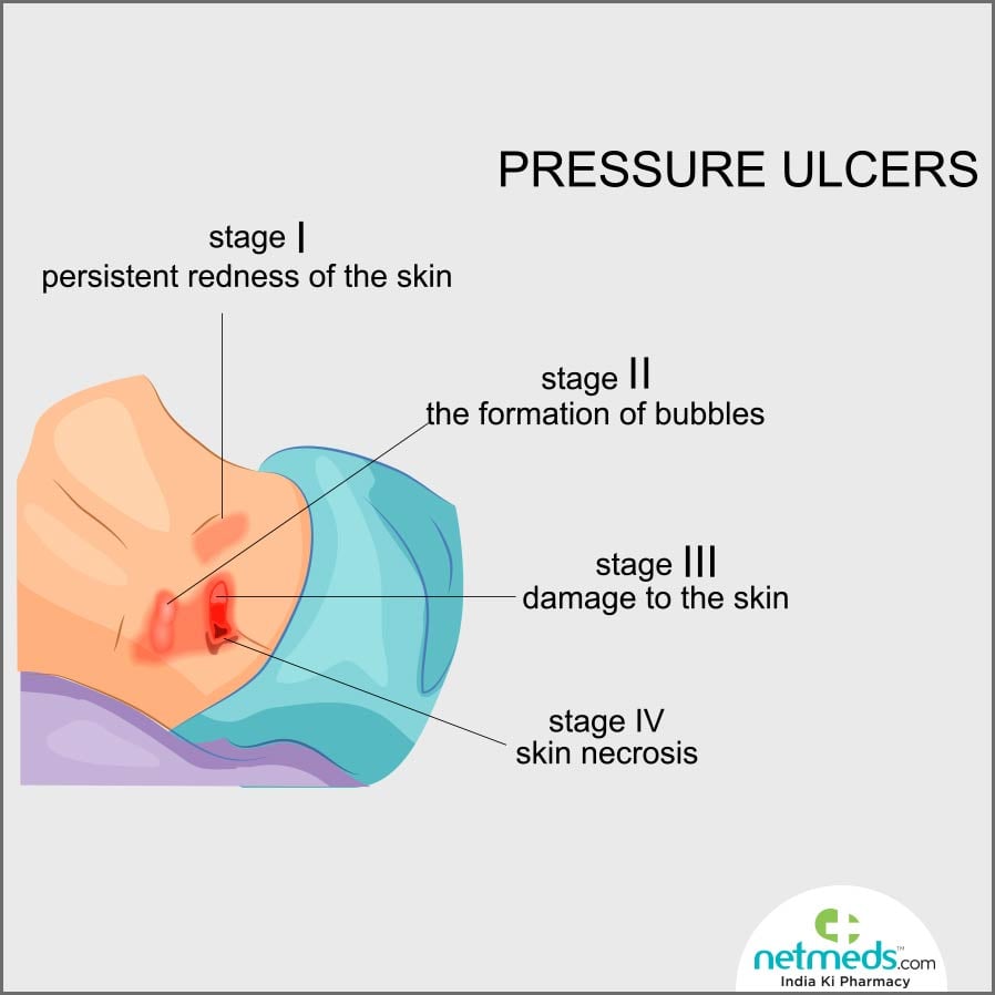pressure ulcer symptoms