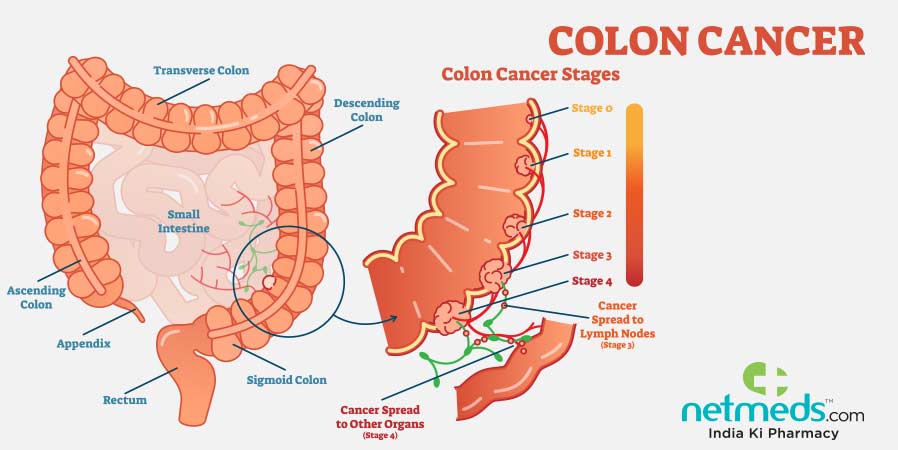 Colon cancer illustration
