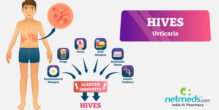 Hives Urticaria