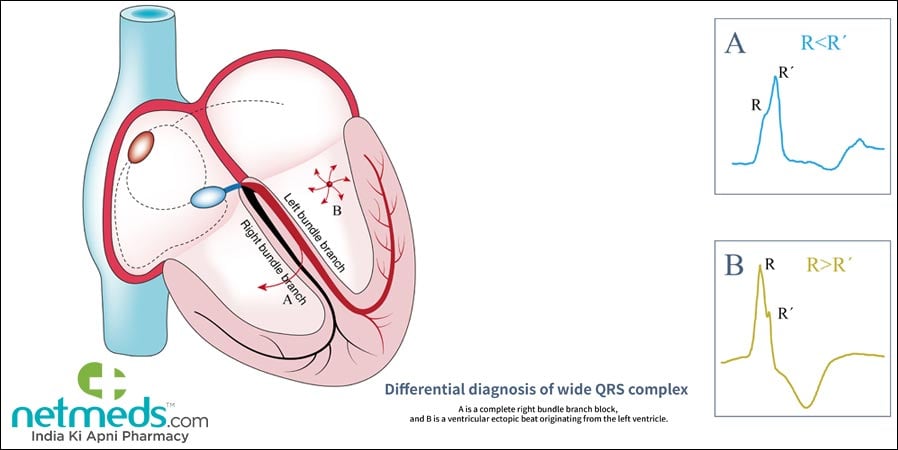 Differential diagnosis of wide QRS complex