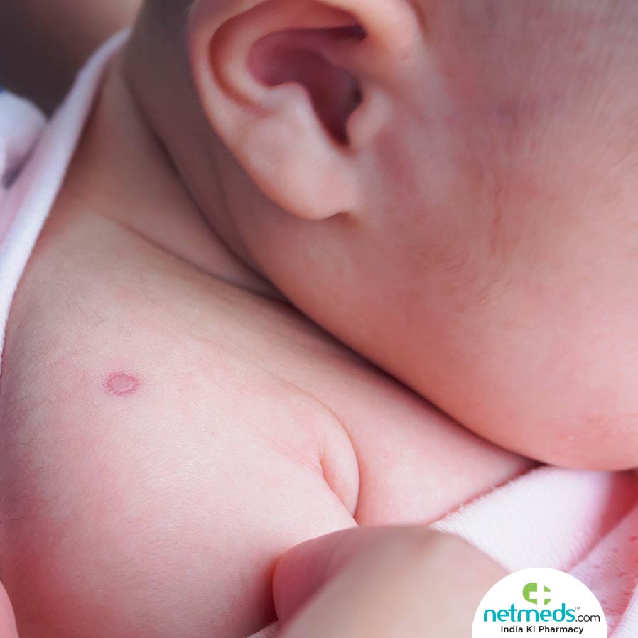 Infantile Hemangioma