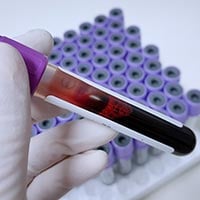 Blood Culture Test: Purpose, Procedure And Results