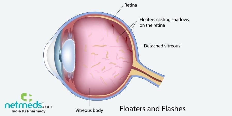 Eye Floaters