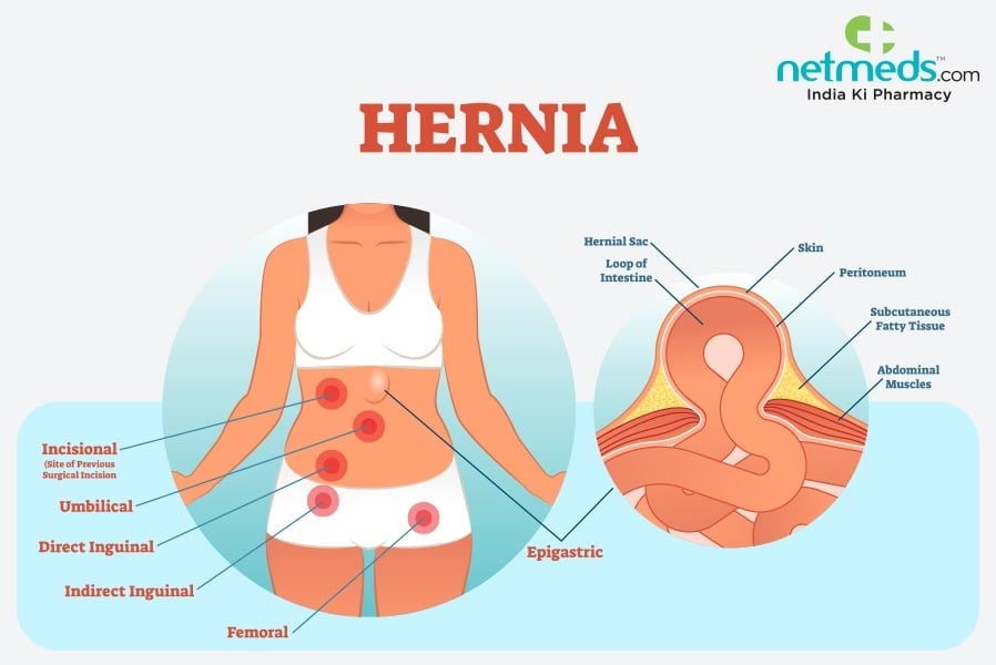 hernia