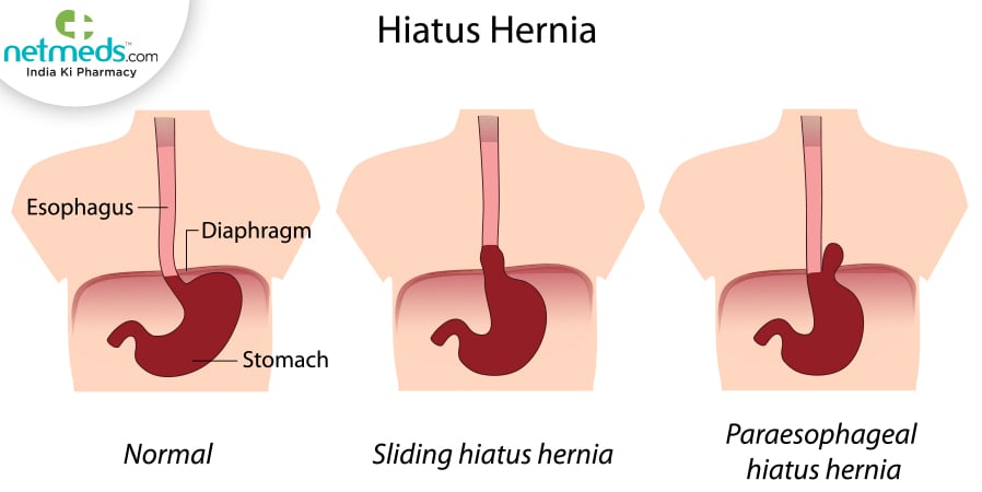 hiatal hernia