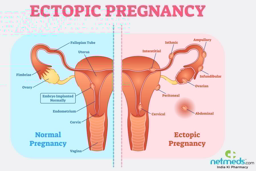 ectopic pregnancy