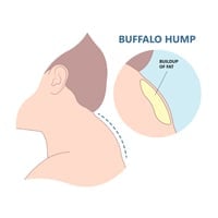 What Is Buffalo Hump: Spectacular Yoga Poses To Get Rid Of Fat Deposits From The Base Of Your Neck
