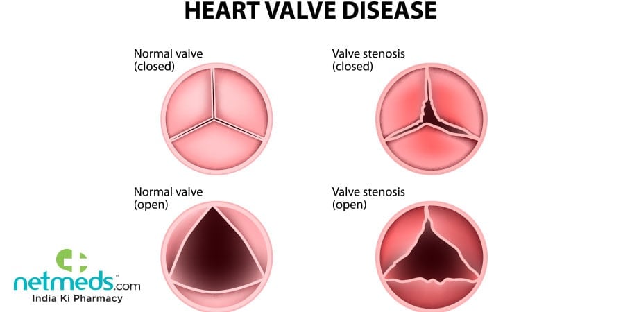 Heart Valve Disease