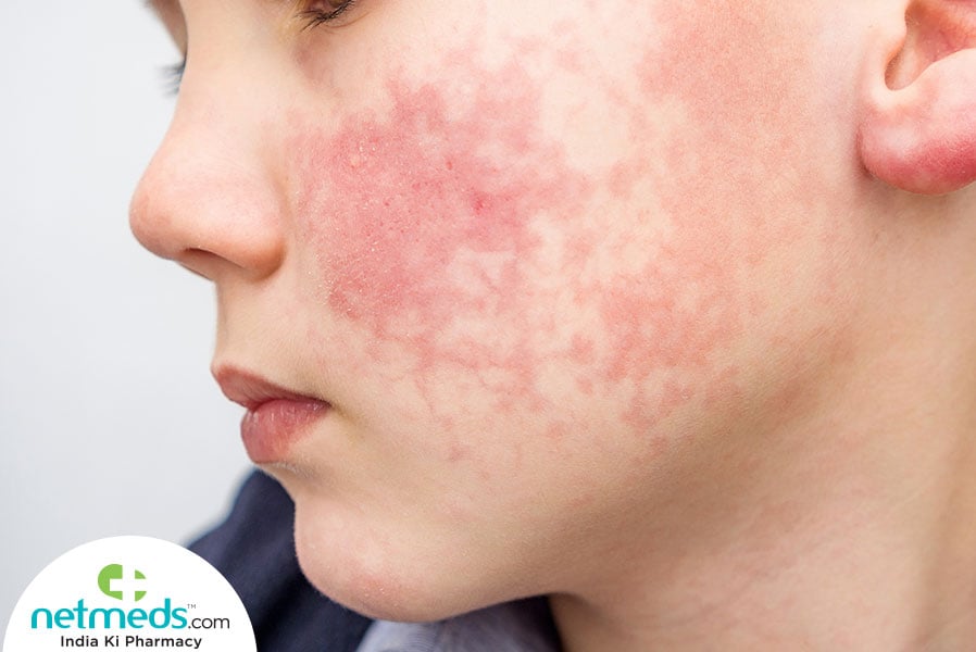slapped cheek syndrome