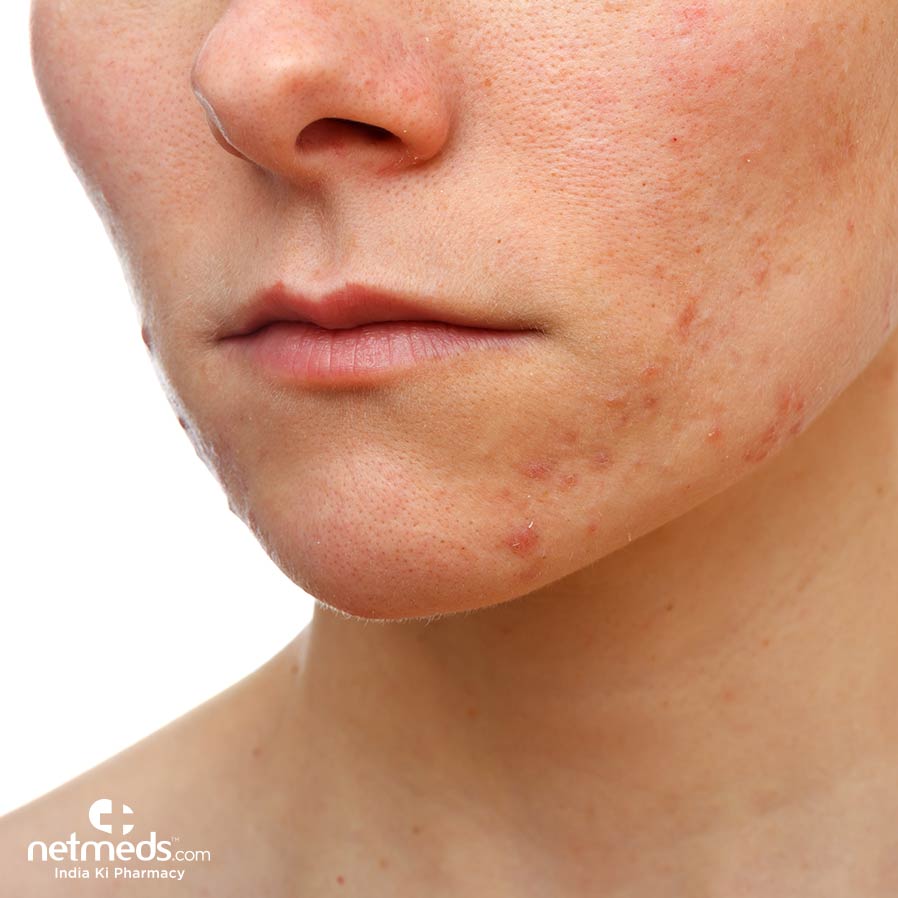 Woman with pimples