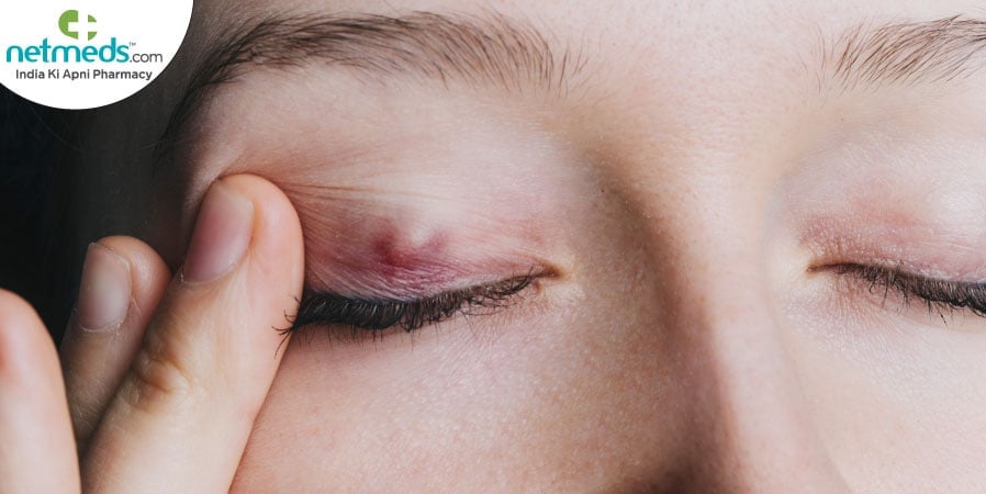 Chalazion/Mebomian cyst