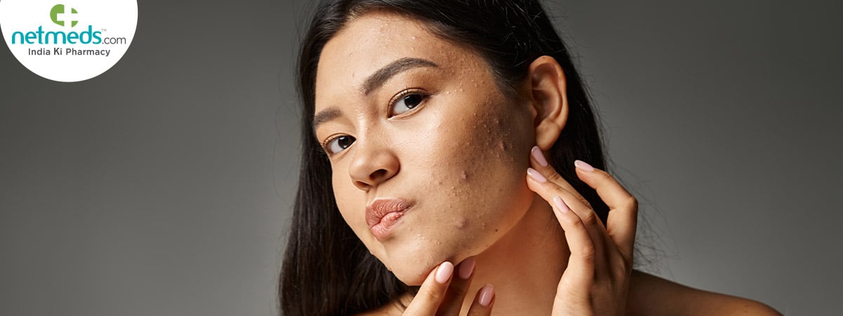 winter acne remedies