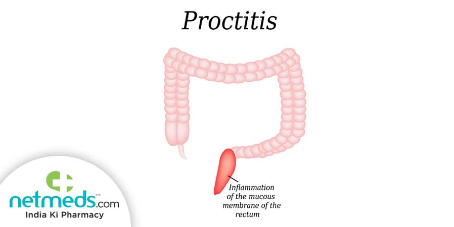 Proctitis