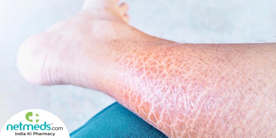 Ichthyosis Vulgaris