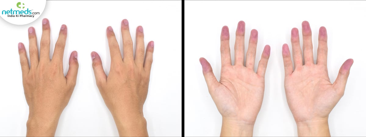Skin changes