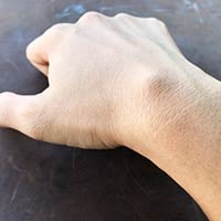 Ganglion Cyst – Causes, Symptoms and Treatment