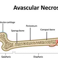 Avascular Necrosis/Osteonecrosis: Symptoms, Causes And Treatment
