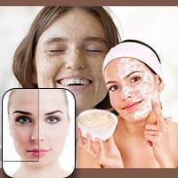 Suffering From Sunspots? Try These 5 Home Remedies That Work For Flawless Skin - Infographic