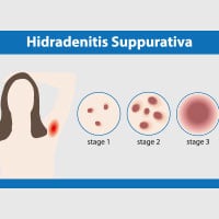 Hidradenitis Suppurativa: The Causes, Symptoms And Treatment Of Acne Inversa