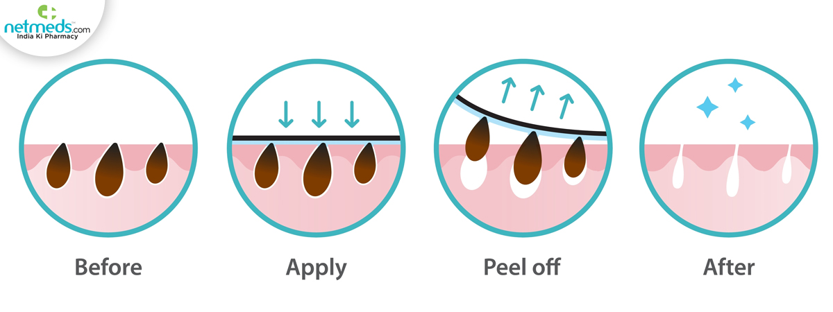 blackhead removal
