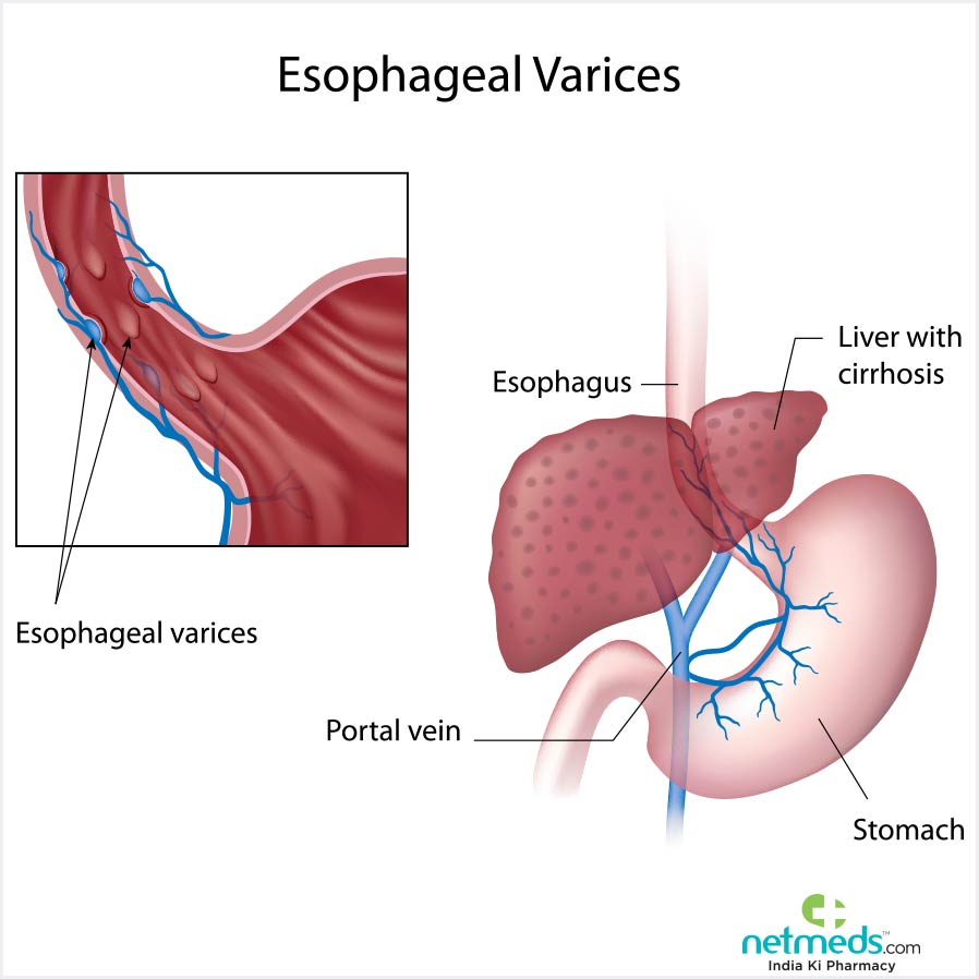 Esophageal Varices