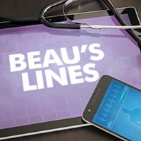 Beau's Lines On Nails: Causes, Symptoms And Treatment