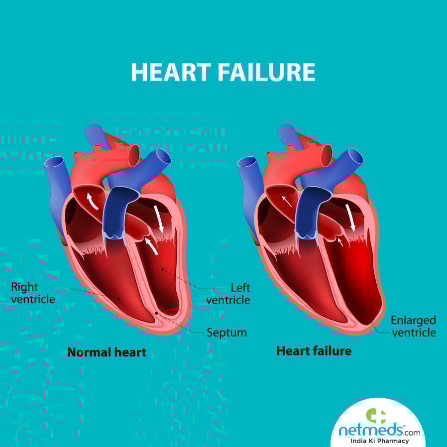 Left ventricular dysfunction