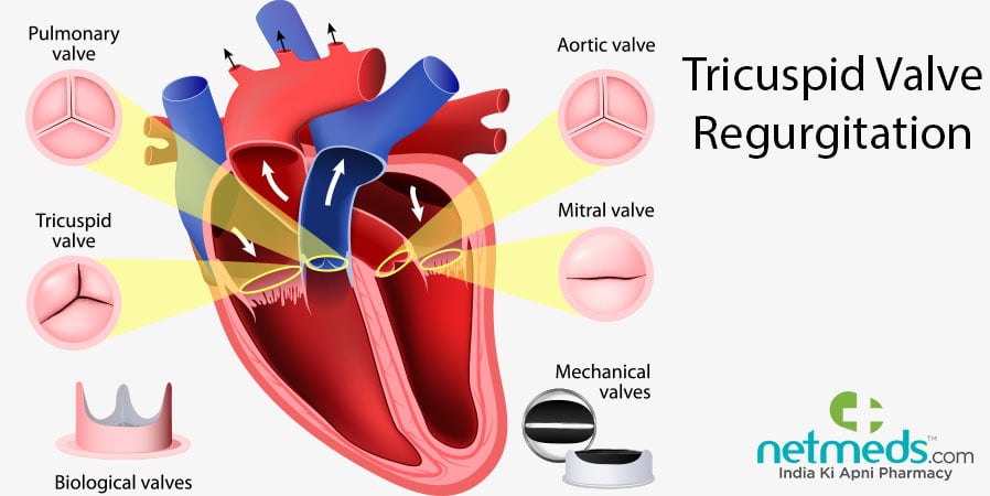 Tricuspid Valve Regurgitation